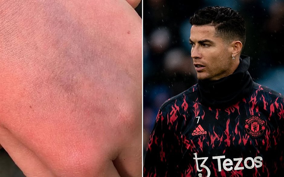 Mãe de torcedor do Everton divulgou foto da mão do jovem após tapa de Cristiano Ronaldo (Liverpool Echo e Manchester United/Divulgação)