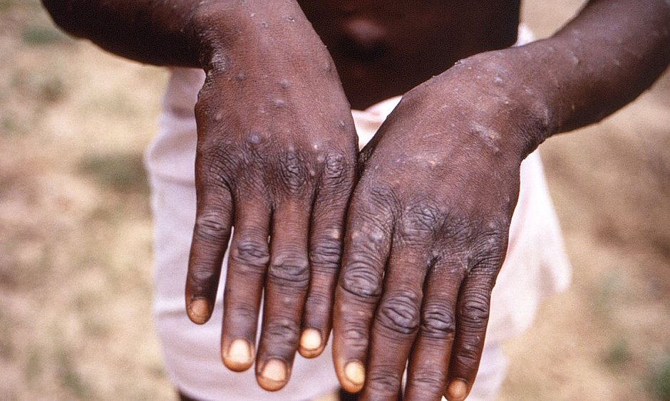 CDC/Brian W.J. Mahy (Varíola do macaco provoca febre e erupções na pele, entre outros sintomas)