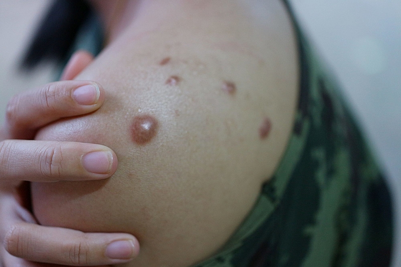 A varíola dos macacos é uma doença viral, descoberta na década de 1970, causa lesões na pele e em casos mais graves pode levar à morte - AFP
